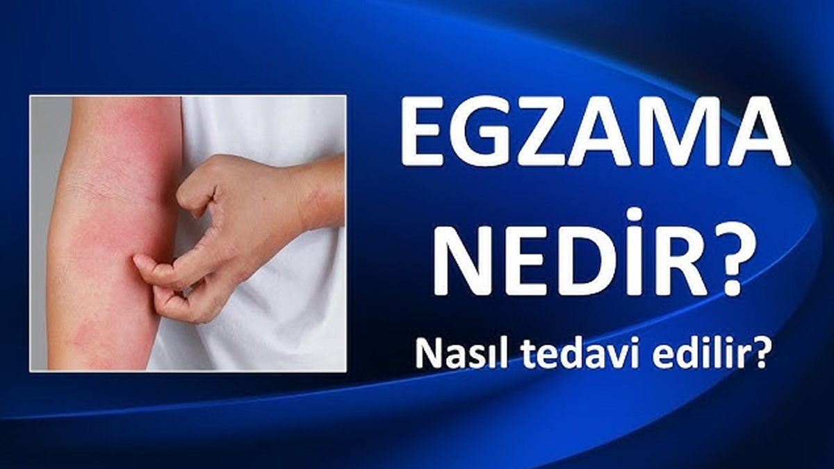 egzama nedir
