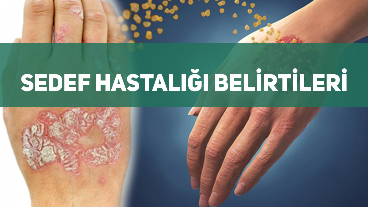 sedef hastalığı belirtileri