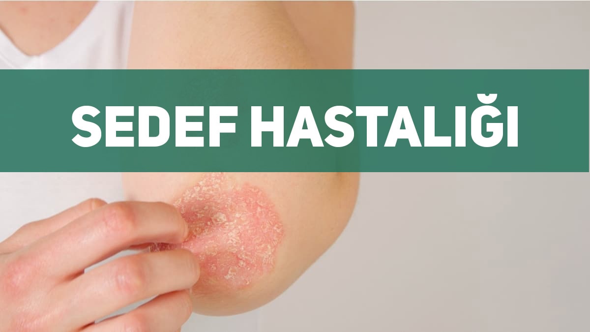 sedef hastalığı nedir