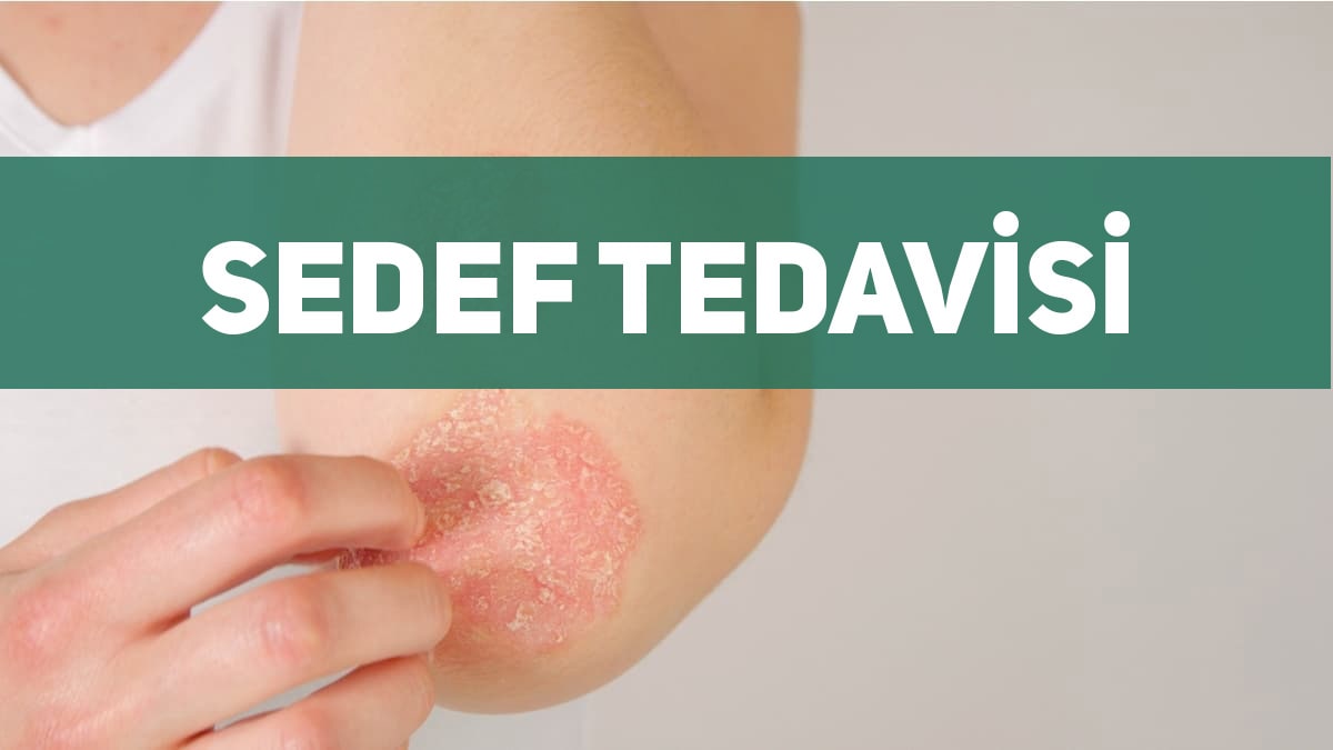 sedef tedavisi